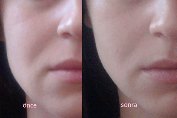 face yoga before after