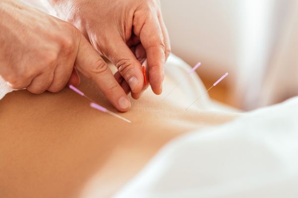 akupunktur iğneleri