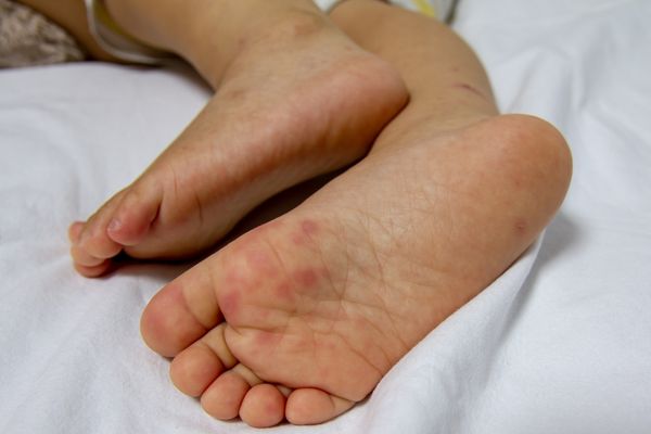 el ayak hastalığı karbonat